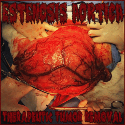 Estenosis Aortica : Therapeutic Tumor Removal